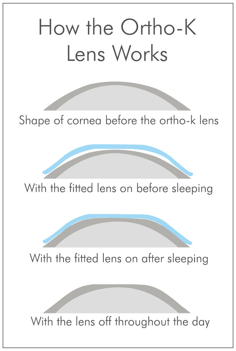 Ortho-K - how it works