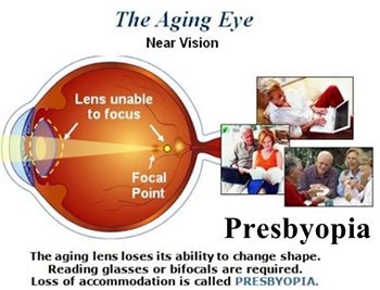 Presbyopia